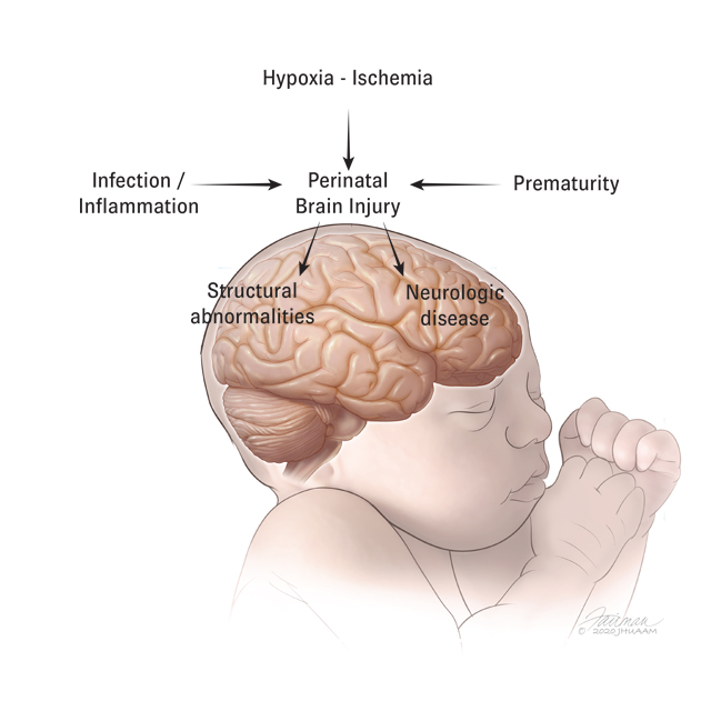 A medical image of an infant shows a sideview of its brain. A flowchart explains that infection and inflammation, hypoxia and ischemia, or prematurity can lead to perinatal brain injury, which can lead to structural abnormalities and neurologic disease.